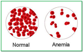 vér_normal_anaemia
